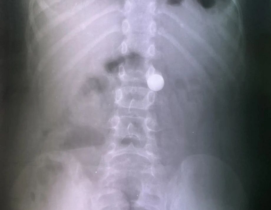 В Балакове восьмилетний мальчик проглотил металлический шарик и попал в больницу